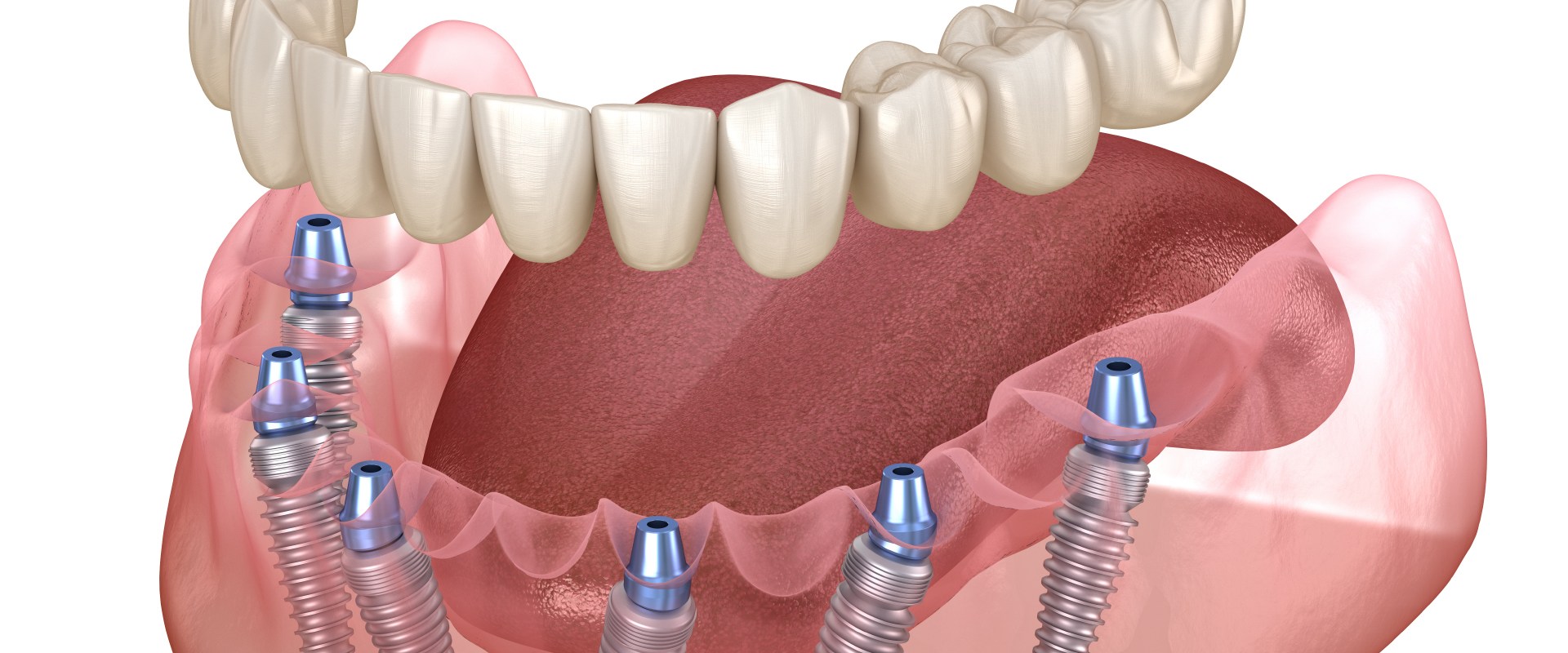 A Complete Guide to Understanding Implant Supported Dentures
