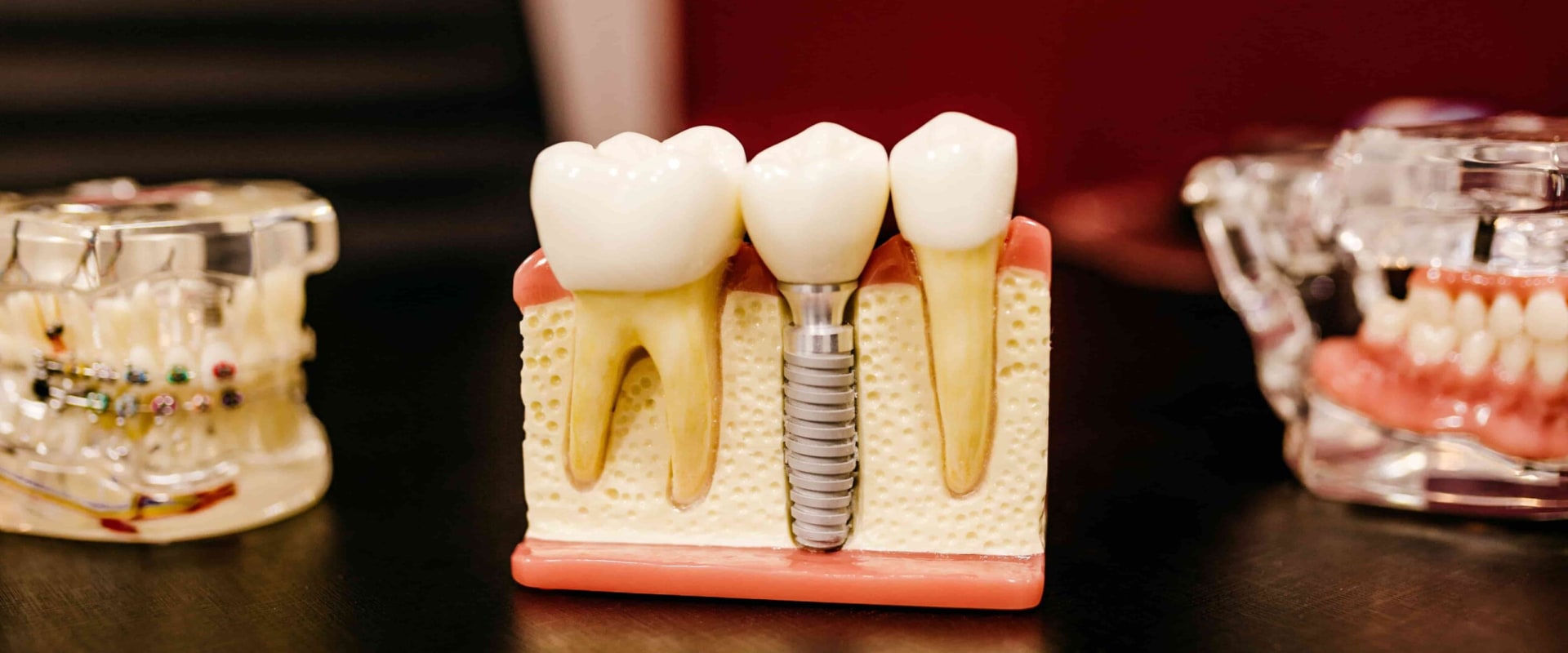 Understanding Nerve Damage: Risks and Complications of Implant Supported Dentures