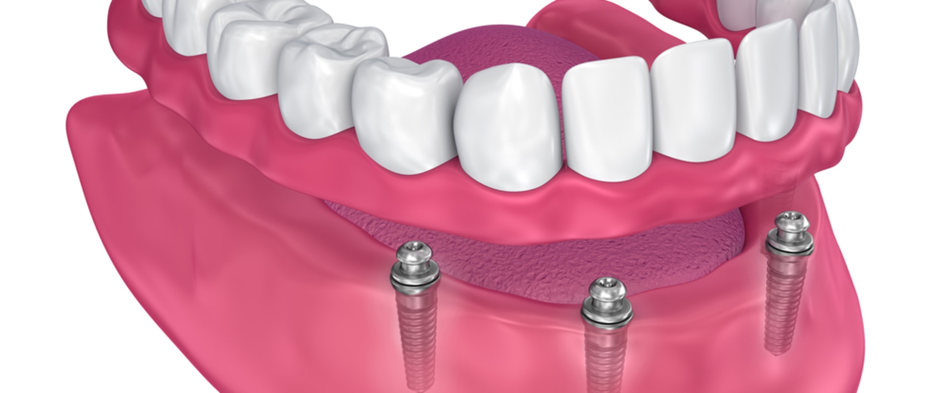 Understanding the Number of Implants Needed for Implant Supported Dentures