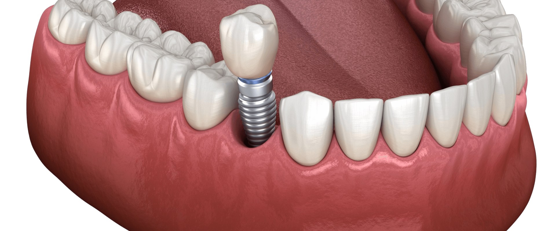 Exploring Discount Programs and Financing Options for Affordable Implant Supported Dentures