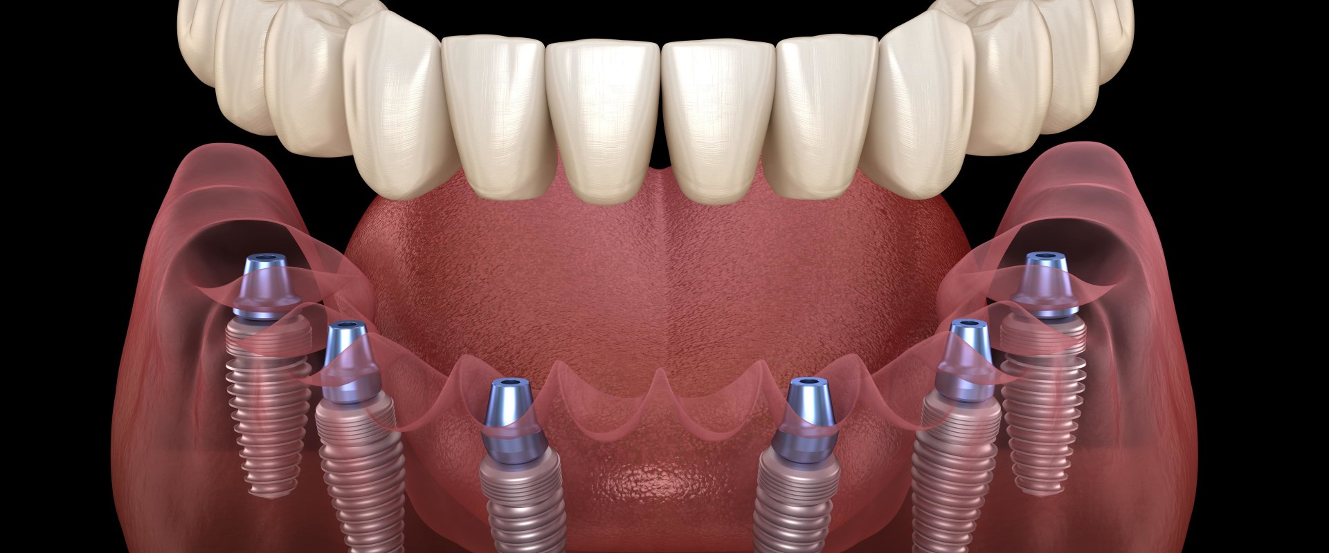 Choosing the Perfect Fit: Comfort and Fit for Implant Supported Dentures