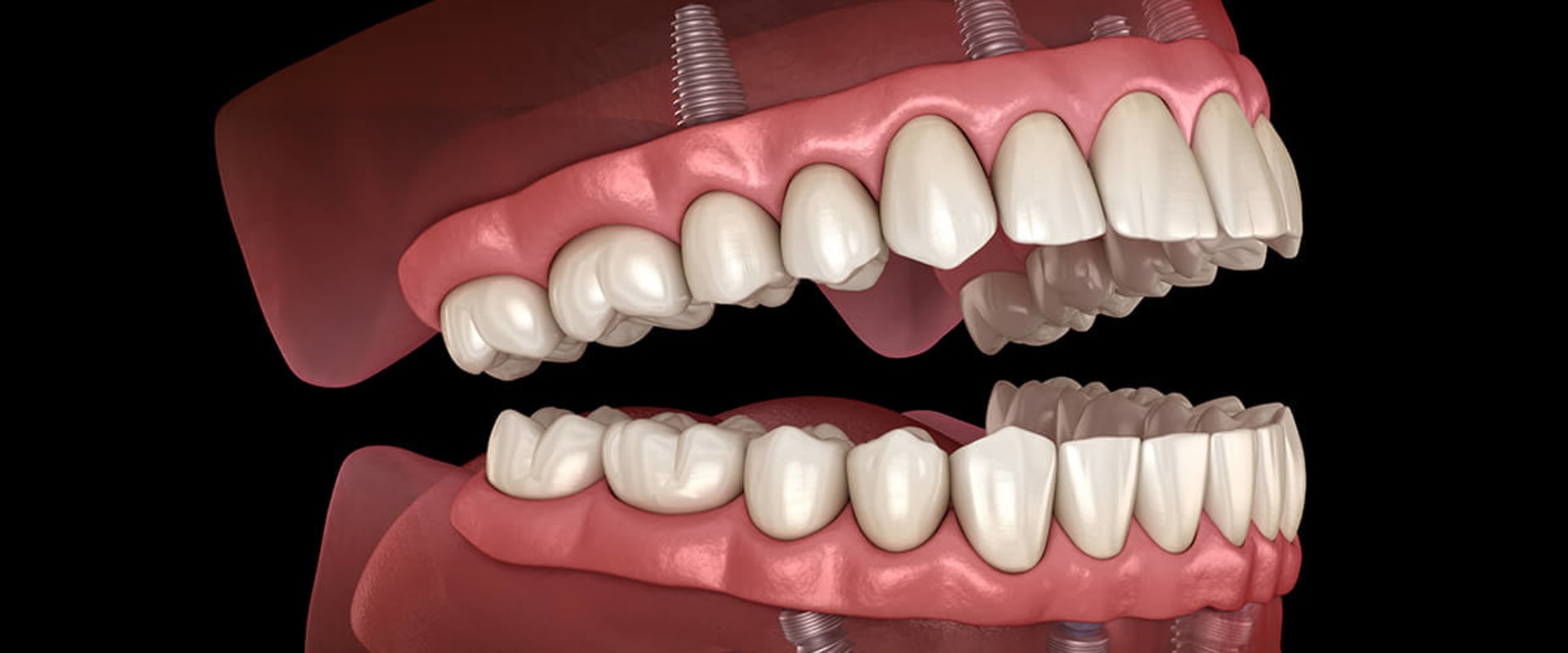 The Cost of Implant Supported Dentures in the US: What You Need to Know