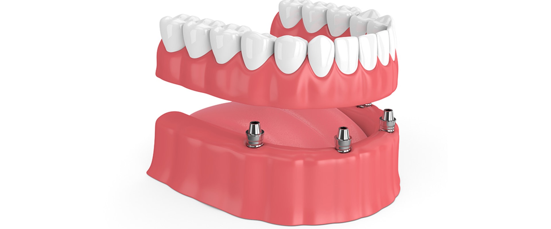 Implant Supported Dentures vs. Traditional Dentures: Which is More Comfortable?