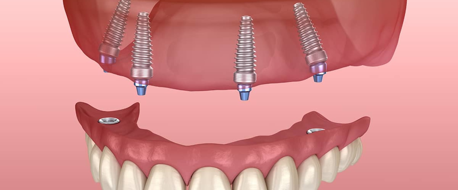 Location and Dentist's Experience: A Comprehensive Look at Factors Affecting Implant Supported Denture Costs
