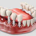 All You Need to Know About Fixed and Removable Dentures