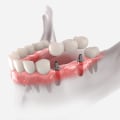 Understanding the Cost of Implant Supported Dentures in Asia