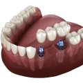 Creating a Budget Plan for Implant Supported Dentures: Tips for Affordable Options