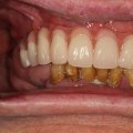 Real Stories From Patients Who Have Received Implant Supported Dentures