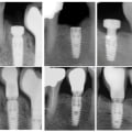 Understanding Implant Failure: Risks and Complications