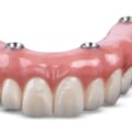 Top Brands for Implant Supported Dentures
