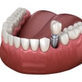 Exploring Discount Programs and Financing Options for Affordable Implant Supported Dentures