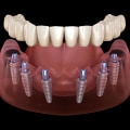 Choosing the Perfect Fit: Comfort and Fit for Implant Supported Dentures
