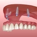 The Basics of Implant Supported Dentures
