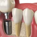 Understanding the Suitability of Different Types of Jaw Bones for Dental Implants