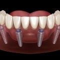 Comparing All-on-4 and Traditional Implant Dentures: Which Is Right for You?