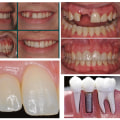 Customizing Implant Supported Dentures: Achieving the Perfect Smile