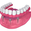 How Implant Supported Dentures Improve Speech