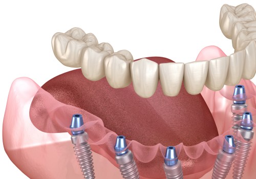 A Complete Guide to Understanding Implant Supported Dentures