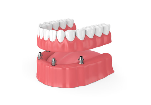 Exploring the Pros and Cons of Using Affordable Implant Supported Dentures: What You Need to Know