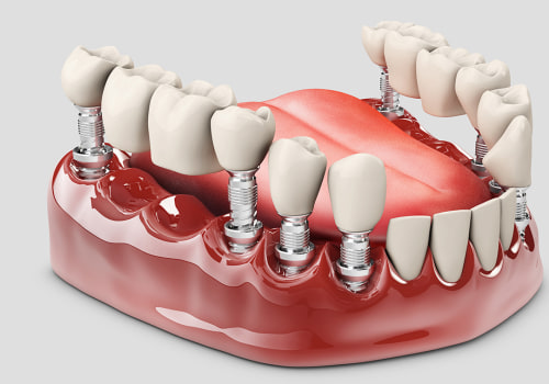 All You Need to Know About Fixed and Removable Dentures