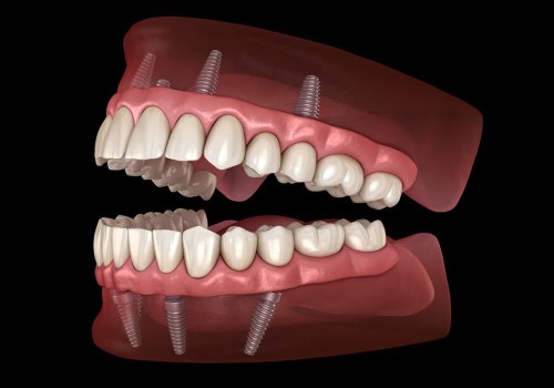 The Cost of Implant Supported Dentures: What You Need to Know