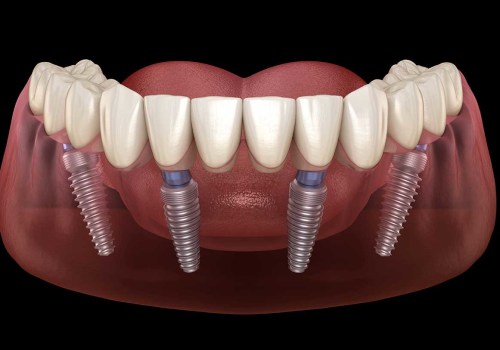 Exploring the Suitability of Implant Supported Dentures for Different Levels of Tooth Loss