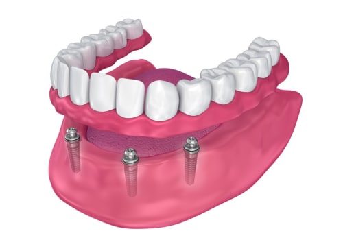 Understanding Recovery and Aftercare for Implant Supported Dentures