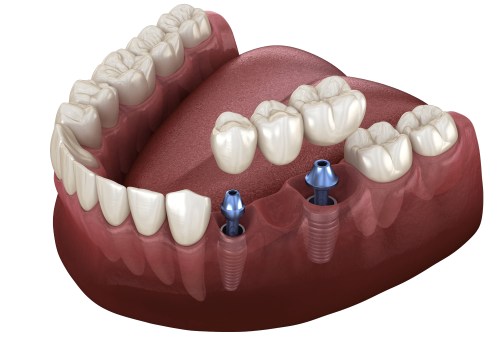 Creating a Budget Plan for Implant Supported Dentures: Tips for Affordable Options