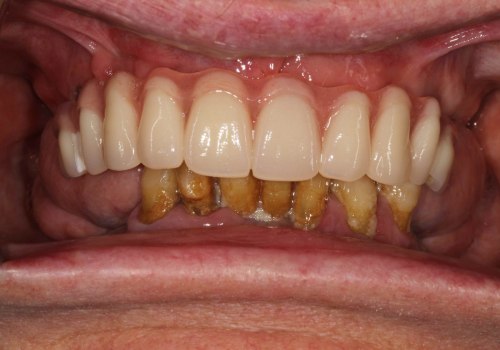 Real Stories From Patients Who Have Received Implant Supported Dentures