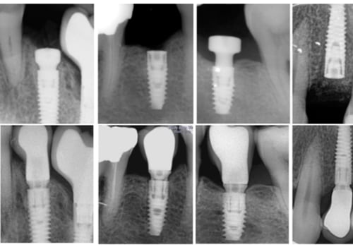 Understanding Implant Failure: Risks and Complications