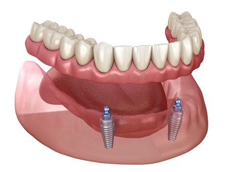 Implant Supported Dentures vs Traditional Dentures: A Comprehensive Comparison of Fit and Comfort
