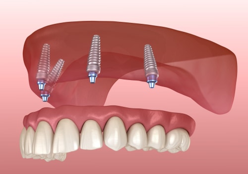 Understanding Infection in the Context of Implant Supported Dentures