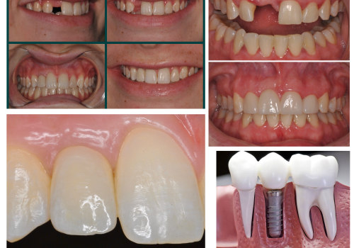 Customizing Implant Supported Dentures: Achieving the Perfect Smile